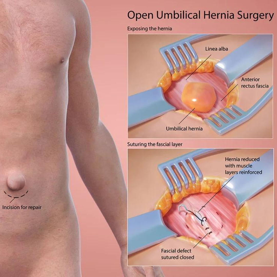 Umbilical Hernia Belt